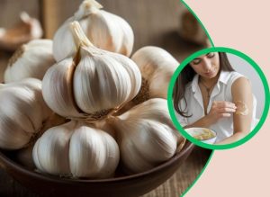 Natural Garlic Skin Tag Remedies to Try at Home