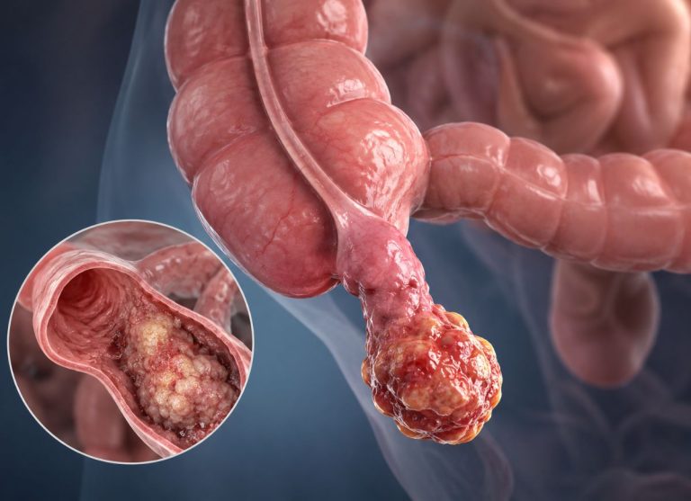 10-Appendix-Cancer-Symptoms-Not-to-Overlook