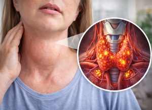 10 Hyperthyroidism Symptoms of an Overactive Thyroid