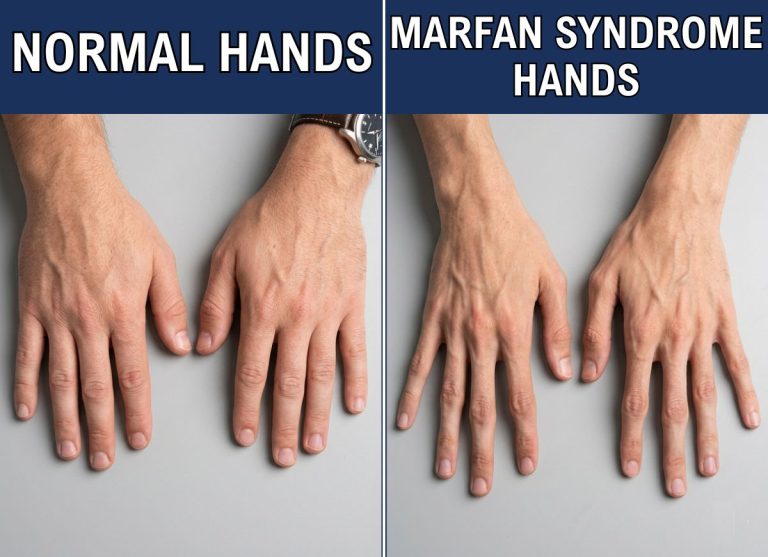 10 Key Marfan Syndrome Symptoms to Watch For