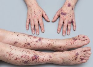 10-Key-Warning-Signs-of-Thrombotic-Thrombocytopenic-Purpura