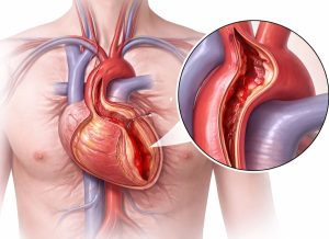 10 Life-Threatening Aortic Dissection Symptoms You Never Ignore