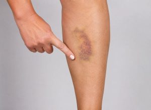 10 Signs of a Hematoma and When to Be Concerned