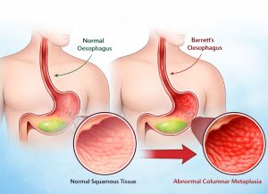 10 Symptoms of Barrett’s Oesophagus and How to Identify Them