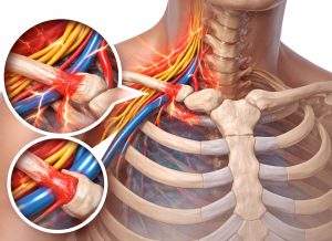 10 Warning Signs of Thoracic Outlet Syndrome and Effective Therapies to Try