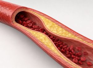 12 Atherosclerosis Warning Signs You Should Never Ignore