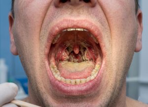 12 Diphtheria Symptoms You Must Recognize