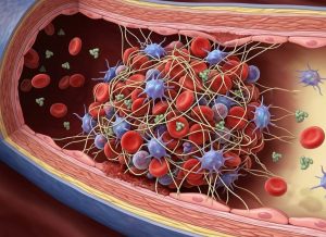 12 Warning Signs of Factor V Leiden Thrombophilia You Should Know