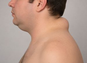 16 Common Cushing Syndrome Symptoms You Shouldn’t Ignore