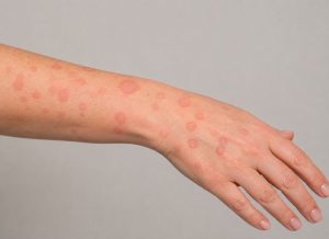 3 Typical Signs of Pityriasis Rosea You Should Know