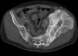 4 Main Symptoms of Paget's Disease of the Bone