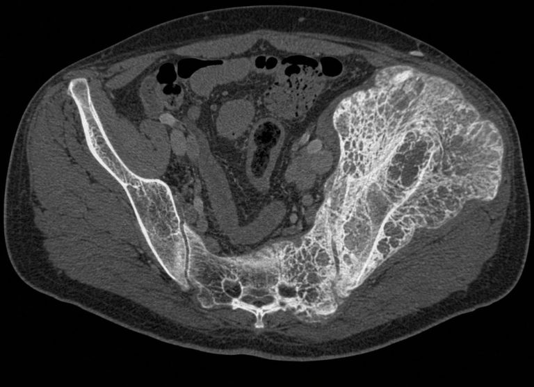 4 Main Symptoms of Paget's Disease of the Bone