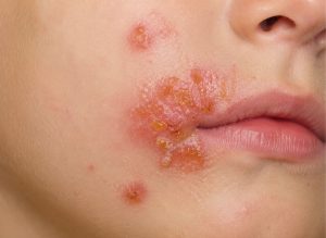 5 Common Symptoms of Impetigo and How to Take Care of It