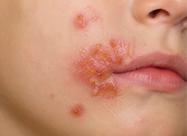 5 Common Symptoms of Impetigo and How to Take Care of It