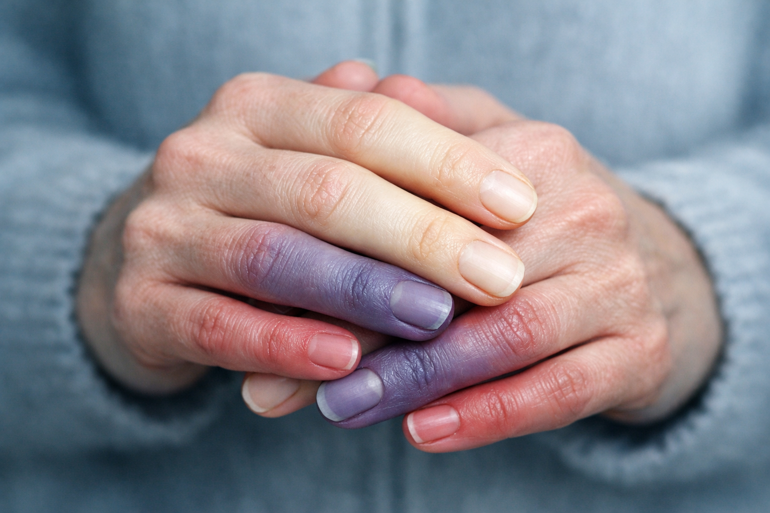 5 Common Symptoms of Raynaud’s Syndrome You Should Never Overlook