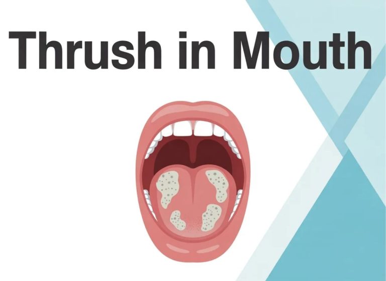 6 Causes of Thrush in Mouth You Might Not Expect