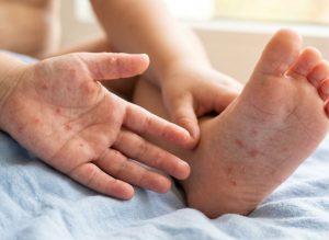 6+ Early Signs of HFMD Disease in Children