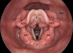 6 Warning Signs of Laryngomalacia in Babies and Infants