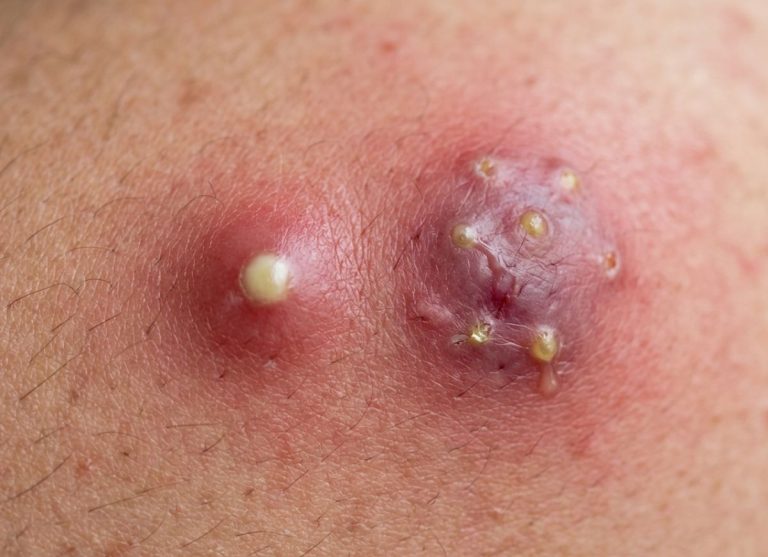 6 Warning Symptoms of Boils and Carbuncles That Demand Attention