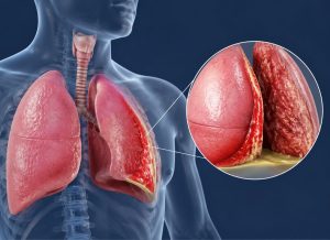 7 Early Warning Signs of Pleurisy Everyone Should Know