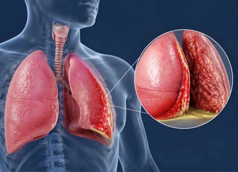 7 Early Warning Signs of Pleurisy Everyone Should Know
