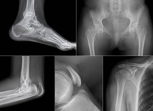 7 Enthesopathy Symptoms to Help You Understand Joint Pain