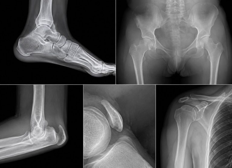 7 Enthesopathy Symptoms to Help You Understand Joint Pain