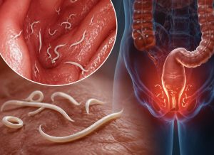 7 Warning Signs of Pinworm Infection to Watch For