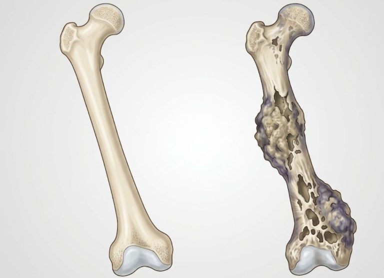 8 Bone Cancer Warning Signs You Should Never Ignore