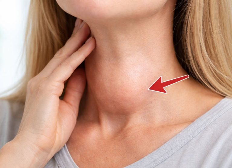 8 Goiter Symptoms That Signal an Enlarged Thyroid