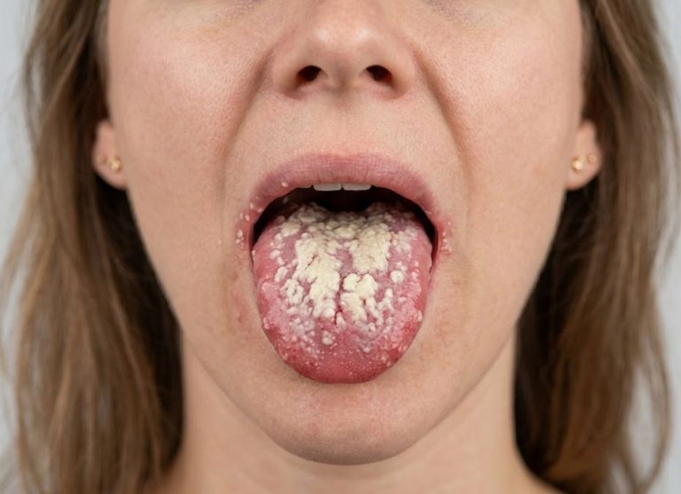 8-Invasive-Candidiasis-Symptoms-of-a-Systemic-Yeast-Infection