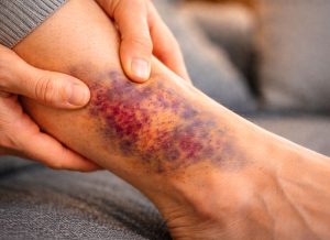 8 Reasons Your Body Might Bruise More Easily Than Others