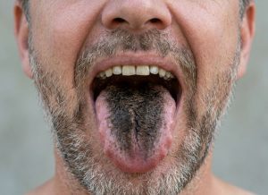 8 Signs You Might Have Black Hairy Tongue