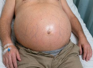8 Warning Signs of Ascites You Should Never Ignore
