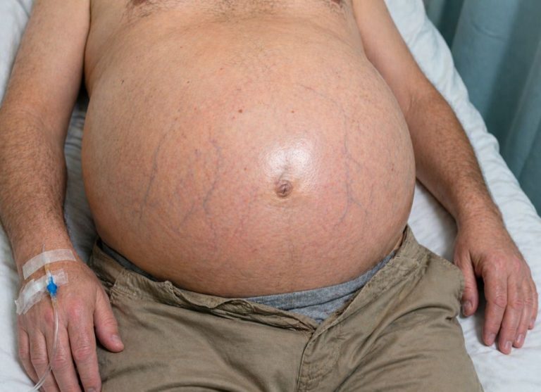 8 Warning Signs of Ascites You Should Never Ignore