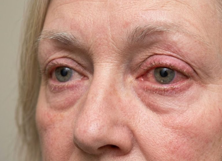 8 Warning Signs of Ocular Rosacea to Watch for