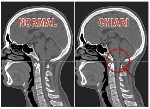 8 Warning Signs of a Chiari Malformation Most People Ignore