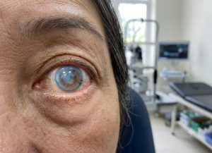 9 Signs of Corneal Edema and What They Mean for Your Vision