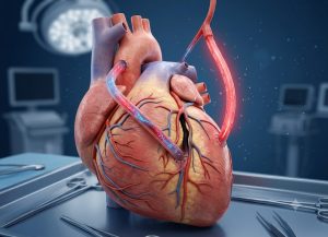 Cardiac Bypass Surgery Recovery Timeline and Possible Side Effects