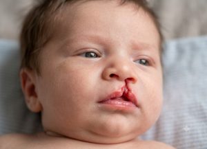 Cleft Lip vs Cleft Palate: 6 Differences Parents Should Understand