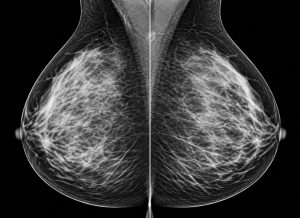 Dense Breast Tissue: What It Is and Why It Matters