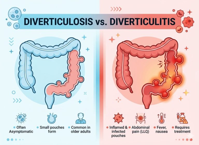 Diverticulosis vs. Diverticulitis: What Is The Difference? By Kare | March 31, 2026 A quiet change inside the digestive system can go unnoticed for years, until one day it becomes sudden, sharp discomfort that demands attention. Many people use the terms diverticulosis and diverticulitis interchangeably, but they describe two very different stages of the same underlying condition. Knowing the difference can help you avoid pain, complications, and unnecessary worry. Diverticulosis is the formation of small pouches, called diverticula, in the wall of the colon. It is extremely common, especially with age, and often causes no symptoms at all. Many people live with it for years without knowing, and it is usually found during routine screenings or tests for unrelated digestive problems. Diverticulitis happens when those pouches become inflamed or infected. That is where trouble begins. Something silent can quickly turn into abdominal pain, fever, bloating, and changes in bowel habits, and serious cases may need urgent medical care. The confusion between the two terms leads to misunderstandings about risk, treatment, and prevention. Some people assume diverticulosis will inevitably cause symptoms, while others miss the early warning signs of diverticulitis until it worsens. This article explains the difference clearly and practically, showing how each condition develops, which symptoms to watch for, and how simple lifestyle changes can protect your digestive health for the long term. Diverticulosis vs. Diverticulitis: What is The Difference? The core difference is simple. Diverticulosis means pouches (diverticula) are present in the colon wall. Diverticulitis means those pouches are inflamed or infected. Diverticulosis is a chronic, structural condition, while diverticulitis is an acute inflammatory event that arises from it. To see how they relate, it helps to look at each one separately. Diverticulosis always comes first, since nobody can develop diverticulitis without it. But having diverticulosis does not mean diverticulitis will follow. Only a small share of people with the condition, roughly 4–5%, ever have an inflammatory attack. What separates the two is whether active inflammation is present in the diverticula. What Exactly Is Diverticulosis? Diverticulosis is a common digestive condition in which small, bulging pouches called diverticula form in the wall of the digestive tract, most often in the lower part of the large intestine (colon). It develops when weak spots in the muscular outer layer of the colon give way under pressure, letting the inner lining push through and form pockets. The main cause is high pressure inside the colon, often linked to a modern, low-fiber diet. Without enough fiber to bulk up stool, the colon must push harder to move smaller, harder stools. This raises pressure inside the colon and strains its wall over time. Several key points describe how diverticulosis forms and behaves: Anatomy of Formation: Diverticula usually form at naturally weak points in the colon wall, where blood vessels (vasa recta) pass through the circular muscle layer to supply the lining. These spots are structurally weaker and can herniate when internal pressure rises. The sigmoid colon is the most common site, accounting for about 95% of cases, because it is the narrowest part of the colon and has the highest internal pressure. Prevalence and Asymptomatic Nature: Diverticulosis is very common, especially in older people and in Western industrialized countries. It appears in fewer than 20% of people under 40 but in about 60% of those over 60. More than 80% of people with it have no symptoms and don't know they have it. It is often found by chance during a colonoscopy or imaging done for other reasons. Symptomatic Uncomplicated Diverticular Disease (SUDD): A small group of people have chronic, on-and-off symptoms without active inflammation. Known as SUDD, it can cause lower abdominal pain, bloating, constipation, or diarrhea. The symptoms often resemble Irritable Bowel Syndrome (IBS) and are thought to involve visceral hypersensitivity, altered gut bacteria, or low-grade inflammation that doesn't meet the definition of acute diverticulitis. When Diverticulosis Becomes Diverticulitis Diverticulosis turns into diverticulitis when one or more diverticula become blocked. This sets off bacterial overgrowth, infection, and inflammation, which cause acute symptoms and can lead to complications. It marks the shift from a passive structural finding to an active, painful disease. The inflammation usually stays around the affected pouch and the nearby colon wall, but untreated it can progress to more serious problems. At the heart of the process is a blockage that turns the open pouch into a closed space, an ideal place for infection to grow. It unfolds in a fairly predictable sequence: Obstruction and Stasis: It usually starts when the opening, or "neck," of a diverticulum gets blocked, often by a small hardened piece of stool called a fecalith. Undigested food particles or thickened mucus can also contribute. With drainage impeded, waste stagnates inside the pouch, creating a nutrient-rich, low-oxygen environment where colon bacteria thrive. Bacterial Overgrowth and Infection: With no way out, the trapped bacteria multiply rapidly. Together with rising pressure inside the sealed pouch, this wears away its thin wall and can create microscopic tears (micro-perforations). The immune system detects the bacteria and tissue damage and mounts a strong inflammatory response. Inflammatory Response and Symptoms: White blood cells rush to the site, producing the classic signs of inflammation: swelling, redness, and pus. The result is the hallmark symptom of diverticulitis, severe and persistent pain in the lower abdomen, usually on the left. The infection also causes fever, chills, and a raised white blood cell count. If surrounding tissue contains the micro-perforation, a local abscess may form. If not, bacteria and stool can leak into the abdominal cavity and cause peritonitis, a widespread and life-threatening infection. How Does Diverticulosis Progress to Diverticulitis? The progression follows a chain of events that begins with a blocked diverticulum. Pressure inside the pouch rises, bacteria multiply, tissue erodes, and the body responds with acute inflammation. A harmless structural abnormality becomes a painful medical condition. The key moment is the micro-perforation of the pouch wall, which lets colon bacteria escape and provokes an immune reaction in the surrounding tissue. Next, we look at the specific triggers behind the inflammation and the risk factors that make progression more likely. Having diverticula is the prerequisite, but whether they become inflamed depends on a mix of mechanical factors, lifestyle choices, and the body's own responses. What Triggers The Inflammation in Diverticula? The main trigger is a mechanical blockage of the pouch opening, typically when a small hardened piece of stool (fecalith) becomes lodged. Bacteria then overgrow and gradually erode the pouch wall. The blockage creates a closed loop inside the diverticulum that prevents its contents from clearing and sets the stage for infection. Colon bacteria, harmless in their normal place, multiply quickly in this stagnant space. The resulting pressure and bacterial activity inflame and injure the thin lining of the pouch. Several linked steps lead to an attack: Fecal Stasis and Bacterial Proliferation: The first step is almost always a blockage. When a fecalith or undigested food lodges in the narrow neck of a diverticulum, it acts like a cork in a bottle. The trapped material decomposes and feeds the huge bacterial population of the colon. As the bacteria multiply, they release toxins and byproducts that irritate and damage the pouch lining. Increased Intrapouch Pressure and Ischemia: Trapped stool and bacterial gas sharply raise pressure inside the sealed pouch. This compresses the small blood vessels feeding its wall and reduces local blood flow (ischemia). Without enough oxygen and nutrients, the tissue weakens and becomes more vulnerable to bacterial toxins and to scraping from the fecalith. Erosion and Micro-perforation: Sustained pressure and poor blood supply eventually wear through the wall, creating a micro-perforation, a tiny tear. This is the pivotal event that turns a simple blockage into active diverticulitis. Once the wall is breached, bacteria and inflammatory substances leak into the surrounding fat and tissue. The immune system treats this as an invasion and responds forcefully, producing the pain, swelling, and fever of an attack. Primary Risk Factors for This Progression The main risk factors for moving from diverticulosis to diverticulitis are a low-fiber diet, a sedentary lifestyle, obesity, smoking, and certain medications such as nonsteroidal anti-inflammatory drugs (NSAIDs). They work by raising pressure inside the colon, promoting inflammation in the body, or weakening the colon's protective lining. Genetics and age, which you can't change, influence whether diverticulosis develops at all. The factors you can change help decide whether it stays dormant or turns into an inflammatory attack. They fall into two groups: lifestyle and diet, and medications and other habits. Lifestyle and Dietary Factors These are the best-established risk factors for diverticulitis. Low-Fiber Diet: A diet lacking fiber, especially one heavy in processed foods and red meat, is the leading risk factor. Fiber bulks up stool, making it softer and easier to pass. Without it, stool turns hard and compact, so the colon works harder and pressure rises. That contributes to diverticula forming and also makes fecaliths and blockages more likely. Obesity: People with a high body mass index (BMI), particularly a larger waist, face a much higher risk. Obesity is linked to chronic low-grade inflammation and may change gut bacteria, both of which can make the colon more prone to an exaggerated inflammatory response. Lack of Physical Activity: A sedentary lifestyle is independently linked to higher risk. Regular activity supports healthy bowel function, shortens transit time, prevents constipation, and so lowers pressure in the colon. Medication and Other Habits Some common medications and habits weaken the colon wall's defenses. NSAIDs and Other Medications: Long-term use of NSAIDs (such as ibuprofen and naproxen) is strongly linked to a higher risk of diverticulitis and its complications, especially perforation. They are believed to block the synthesis of prostaglandins, which protect the lining of the digestive tract, leaving it easier to injure. Steroids and opiates have also been implicated. Smoking: Tobacco is a known risk factor for many inflammatory conditions. In diverticular disease, smoking is associated with a greater likelihood of complicated diverticulitis, suggesting it may worsen inflammation or impair healing. Symptoms of Diverticulosis vs. Diverticulitis Diverticulosis typically causes no symptoms, while diverticulitis brings acute and distinct ones, most notably severe abdominal pain, fever, and nausea. This contrast is the clearest way to tell the two apart. Diverticulosis is a silent structural feature for most people, whereas a diverticulitis attack is painful and unmistakable. Signs of Asymptomatic Diverticulosis Most people with diverticulosis have no signs or symptoms. A small percentage have mild, occasional abdominal discomfort such as cramping, bloating, or constipation. These symptoms are vague and overlap with other digestive disorders like Irritable Bowel Syndrome (IBS), so diverticulosis is rarely suspected until an unrelated exam turns it up. For most people it stays completely silent for life, a structural finding with no clinical significance. The picture looks like this: The Silent Majority: Over 80% of people with diverticulosis have no symptoms at all. They don't feel pain, discomfort, or bowel changes because of the pouches. The presence of diverticula alone doesn't disrupt colon function or cause pain. That's why many people never learn they have it, and why it is often found by chance during a screening colonoscopy. Mild and Vague Symptoms: When symptoms occur without inflammation, they are usually mild and inconsistent. People may report occasional crampy pain, usually in the lower left abdomen, that eases after passing gas or a bowel movement. Others notice bloating, a feeling of fullness, or bowel changes, most often constipation, sometimes diarrhea or alternating between the two. These symptoms lack the severity, persistence, and whole-body signs (like fever) of acute diverticulitis. Symptomatic Uncomplicated Diverticular Disease (SUDD): Gastroenterologists increasingly use this term for people with known diverticulosis who have persistent abdominal symptoms without obvious inflammation. The cause isn't fully understood but is thought to involve visceral hypersensitivity (an amplified pain response to normal gut activity), changes in the gut microbiome, and low-grade inflammation too mild to count as diverticulitis. This helps separate chronic, milder symptoms from an acute attack. Symptoms of a Diverticulitis Attack The classic picture is sudden, persistent, severe pain in the lower-left abdomen, along with fever, chills, nausea, vomiting, and a clear change in bowel habits. Unlike the vague discomfort sometimes seen with diverticulosis, these symptoms are acute and severe and point to an active infection and inflammation that need prompt medical attention. The presentation is often so distinctive that doctors can diagnose it with good confidence from your history and a physical exam. The hallmark symptoms fall into two groups: pain with signs of infection, and related digestive symptoms. Pain and Systemic Signs of Infection These are the most reliable indicators of an attack: Abdominal Pain: The cardinal symptom. The pain is constant and severe, often sharp or stabbing, and builds over a few hours to a day. In over 70% of cases it is in the lower-left abdomen, where the sigmoid colon sits. The area is tender to touch, and movement, coughing, or pressing on it can make the pain worse. In some people, particularly those of Asian descent, the pain occurs in the lower right if diverticula on the right side of the colon are affected. Fever and Chills: A fever is a clear sign the body is fighting an infection. Body temperature is often raised and may come with chills or shaking. The height of the fever can reflect how severe the infection is. Associated Gastrointestinal and Other Symptoms Inflammation disrupts normal colon function and causes other symptoms: Nausea and Vomiting: Many people lose their appetite, feel nauseated, and may vomit because of intense pain and the effect of inflammation on the digestive tract. Changes in Bowel Habits: Constipation is common because inflammation slows the passage of stool. Less often, people get diarrhea. Blood in the stool is uncommon with diverticulitis but can occur. Urinary Symptoms: If the inflamed part of the colon lies near the bladder, it can irritate it and cause frequent or urgent urination, or pain when urinating (dysuria). Diverticulitis Pain vs. Irritable Bowel Syndrome (IBS) pain Both conditions can cause abdominal pain, but the type, location, and accompanying symptoms differ, reflecting very different causes. Diverticulitis pain comes from an acute inflammatory, often infectious process. IBS pain comes from a functional disorder of gut-brain interaction and does not involve inflammation. Diverticulitis pain starts suddenly, is severe and constant, and is highly localized, most often in the lower-left abdomen where the sigmoid colon and most diverticula are found. It comes with clear signs of infection and inflammation, including fever, chills, nausea, and tenderness on examination. Blood tests show raised inflammatory markers, confirming a body-wide response to infection. IBS pain, in contrast, is chronic and comes and goes. It is often crampy and can range from mild to severe. Rather than staying in one spot, it tends to be more spread out and may seem to move around the abdomen. A key feature is its link to bowel movements: the pain often eases after passing stool or gas. IBS is neither inflammatory nor infectious, so it doesn't cause fever, chills, or a raised white blood cell count. Its main accompanying symptoms relate to bowel function, such as bloating, excess gas, and changes in habits like chronic diarrhea, constipation, or a mix of both. In short, diverticulitis is an acute illness with localized pain and signs of infection, while IBS is a chronic functional disorder with crampy, motility-related pain and no evidence of inflammation. Diverticulitis Diagnosis Diagnosis combines a physical exam, lab tests, and imaging to confirm inflammation and rule out other conditions. A healthcare provider starts by reviewing your symptoms and medical history, then examines your abdomen for tenderness, especially in the lower left where the sigmoid colon lies. Blood tests check for infection and inflammation: the white blood cell count (WBC), which is often raised during an attack, and markers such as C-reactive protein (CRP) and erythrocyte sedimentation rate (ESR). These show that inflammation is happening but are not specific to diverticulitis. The definitive test is imaging, and a Computed Tomography (CT) scan of the abdomen and pelvis is the most common and accurate. It shows the colon and surrounding tissue clearly, confirms inflamed diverticula, measures wall thickness, and reveals complications such as an abscess or perforation. When radiation is a concern, such as in pregnancy or younger patients, an ultrasound or Magnetic Resonance Imaging (MRI) may be used. A colonoscopy is usually avoided during an acute episode because of the risk of perforating the inflamed bowel. It is an important follow-up, though, typically done 6 to 8 weeks after the inflammation clears, to assess the full extent of diverticulosis and, above all, to rule out other conditions such as colorectal cancer, which can look similar. Diverticulitis Treatment Options Treatment depends on how severe the attack is, from home care for mild cases to intensive hospital treatment for severe or complicated ones. In uncomplicated diverticulitis, with mild symptoms and no signs of significant complications, people can often manage at home with a doctor's guidance. The focus is resting the colon so it can heal. A clear liquid diet, including broth, clear juices, and gelatin, is recommended for the first few days. As symptoms improve, you move to a low-fiber diet before slowly bringing high-fiber foods back. Acetaminophen can manage pain, but NSAIDs like ibuprofen and naproxen are usually discouraged because they can raise the risk of complications. Oral antibiotics were once standard for every case, but recent guidelines suggest they may not be needed for very mild, uncomplicated cases in otherwise healthy people, since bowel rest alone can sometimes be enough. Severe or complicated diverticulitis requires hospitalization. This applies when someone has intense pain, a high fever, can't keep fluids down, or shows complications on a CT scan. In hospital, intravenous (IV) antibiotics deliver medication straight into the bloodstream for a faster, stronger effect. Patients also get IV fluids to prevent dehydration and strong pain medication. If an abscess has formed, a radiologist may perform percutaneous drainage, using a needle through the skin to drain the pus. If there is a large abscess, perforation, obstruction, or fistula, or if medical treatment fails, surgery may be needed to remove the diseased section of the colon. Diverticulitis Complications If diverticulitis isn't treated effectively, or if attacks are frequent and severe, serious and potentially life-threatening complications can follow. They occur when inflammation and infection spread beyond the colon wall and damage surrounding tissues and organs. One of the most common is an abscess, a walled-off collection of pus near the inflamed pouch. Small abscesses may clear with antibiotics alone, but larger ones often need drainage through a catheter placed by an interventional radiologist to keep them from rupturing. Another major complication is a fistula, an abnormal tunnel linking the colon to another organ. The most common is a colovesical fistula, connecting the colon and bladder, which can cause repeated urinary tract infections or air or stool passing during urination. Others connect to the vagina (colovaginal fistula) or the skin (colocutaneous fistula). Repeated inflammation can also cause scarring and strictures that narrow the colon and lead to a bowel obstruction. Stool can't pass, causing severe constipation, a swollen abdomen, and vomiting, and surgery is often needed. The most dangerous complication is perforation, where the inflamed pouch ruptures completely and spills intestinal contents into the abdomen. This causes peritonitis, a widespread, severe infection of the abdominal lining. It is a medical emergency needing immediate surgery to clean the abdomen and often remove the damaged part of the colon. Without prompt treatment, peritonitis can lead to sepsis and death. FAQs 1. What is more serious, diverticulitis or diverticulosis? Diverticulitis is more serious because it involves active inflammation or infection. Diverticulosis usually stays silent and harmless. Once inflammation sets in, symptoms such as sharp abdominal pain, fever, and digestive disruption can appear. In advanced cases, complications like abscesses or bowel blockage may occur and require treatment, sometimes in hospital. 2. What's the best cure for diverticulosis? There is no complete cure for diverticulosis, but the right habits keep it well controlled. A fiber-rich diet softens stool and lowers pressure in the colon. Drinking enough water supports smoother digestion, and regular physical activity keeps bowel movements consistent. Over time, these changes can greatly reduce the risk of flare-ups and improve digestive comfort. 3. How do you know if your diverticulosis has turned into diverticulitis? Noticeable symptoms usually make it clear. Persistent or worsening pain in the lower abdomen, especially the left side, is a key sign. Fever, nausea, bloating, and sudden bowel changes often follow. Unlike diverticulosis, which typically has no symptoms, diverticulitis causes discomfort that tends to intensify rather than fade. 4. Can diverticulosis go away without antibiotics? Diverticulosis doesn't need antibiotics because it isn't caused by infection. The pouches stay in the colon, but lifestyle changes can keep symptoms to a minimum. Antibiotics are only needed if diverticulitis develops and there is an infection. 5. How to stop diverticulosis from becoming diverticulitis? Prevention is about reducing pressure and irritation in the colon. Regular fiber from fruits, vegetables, and whole grains supports healthy digestion. Staying hydrated, avoiding chronic constipation, limiting processed foods, and staying active all protect the colon wall. These simple habits make a real difference over time. Conclusion The difference between diverticulosis and diverticulitis is more than medical vocabulary. It describes two very different experiences in the same digestive system. One can sit quietly for years, while the other can suddenly disrupt daily life with pain and complications. Understanding the difference gives you a chance to prevent problems. When early signs are recognized and risk factors managed, the chance of inflammation drops. Diet, hydration, and movement are not minor details. They shape how your digestive system works over time. Awareness also removes uncertainty. Knowing when symptoms signal a shift from a mild condition to a more serious one lets you respond faster and get more effective care. With the right knowledge and consistent habits, long-term digestive health becomes something you can actively protect rather than passively manage.