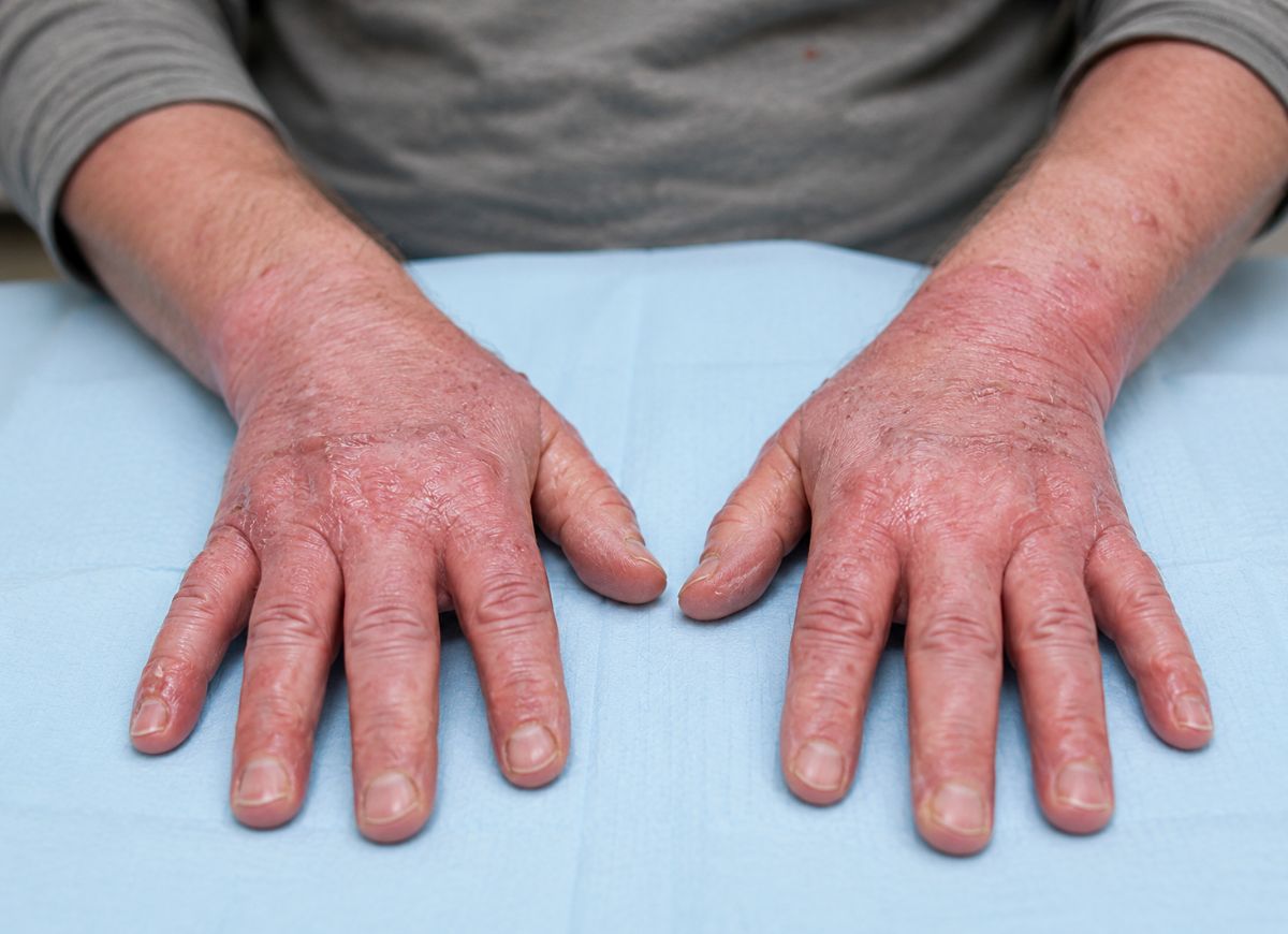 Graft-vs.-Host-Disease-Causes-Symptoms-and-Treatment-Explained