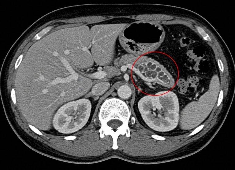 IPMN Explained: Symptoms, Diagnosis, and Treatment Options