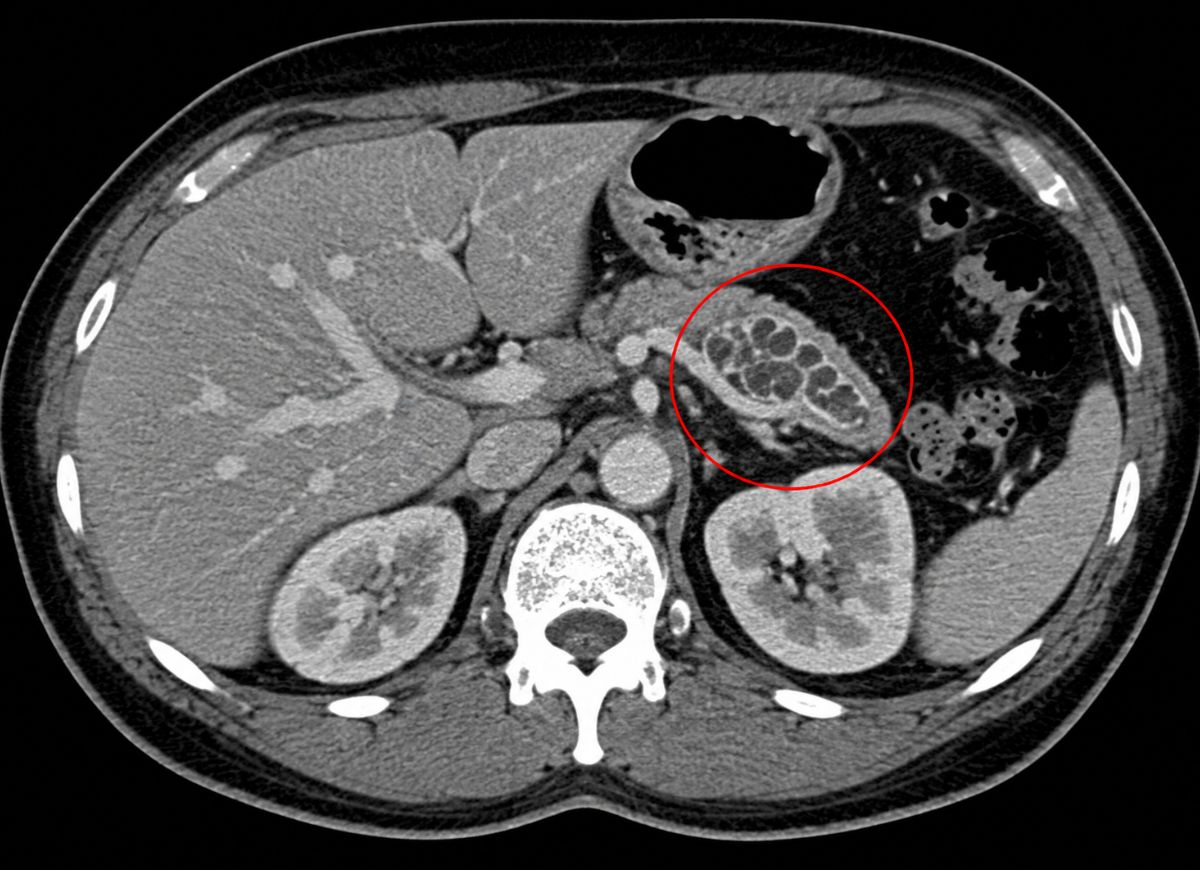 IPMN Explained: Symptoms, Diagnosis, and Treatment Options