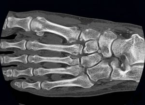 Lisfranc-Injury