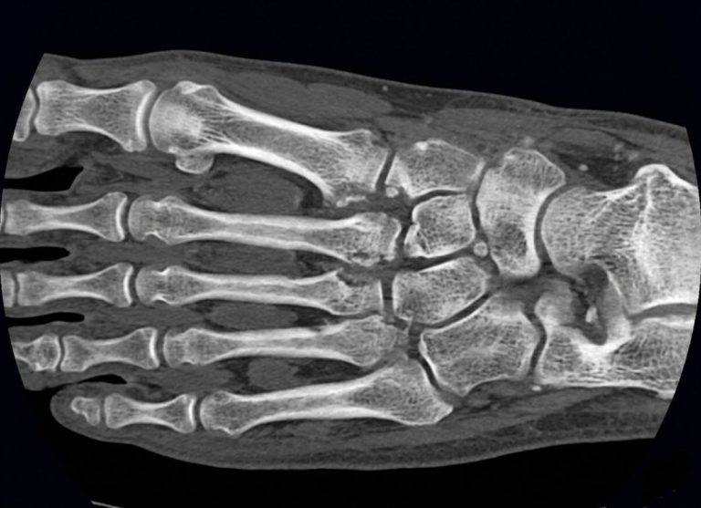 Lisfranc-Injury