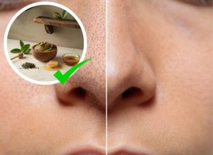 10 DIY Remedies to Remove Blackheads Naturally Using Common Ingredients