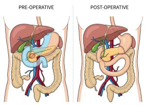 What Is the Whipple Procedure? Causes, Benefits, Risks, and Recovery