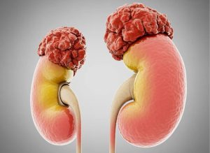 6 Early Common Signs of Adrenal Cancer To Know